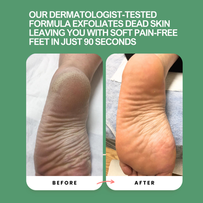 Instant Foot Peeling Spray